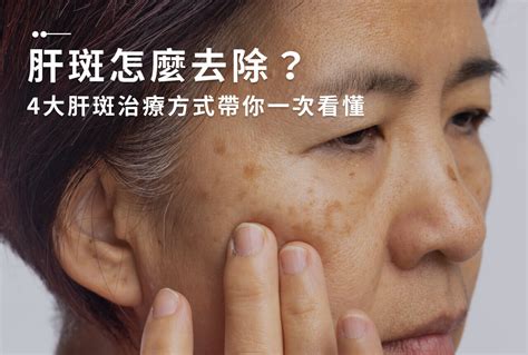 顴骨斑|一次解析曬斑、肝斑、雀斑、顴骨母斑等皮膚黑斑原因…